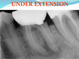 principles of tooth preparations | PPTX
