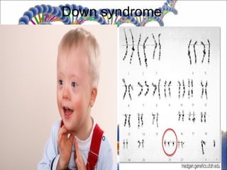 Down syndrome
 