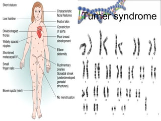 Turner syndrome
 
