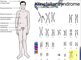 Klinefelter syndrome
 