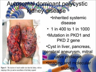 Autosomal dominant polycystic
      kidney disease
                 •Inherited systemic
                       disease
               • 1 in 400 to 1 in 1000
               •Mutation in PKD1 and
                     PKD 2 gene
              •Cyst in liver, pancreas,
             cerebral aneurysm, mitral
                   valve prolapse.
              •Imaging and molecular
                       studies
 