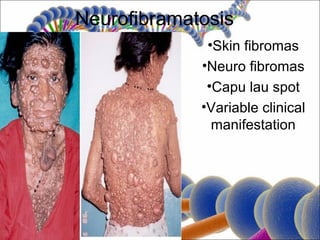 Neurofibramatosis
              •Skin fibromas
             •Neuro fibromas
              •Capu lau spot
             •Variable clinical
               manifestation
 