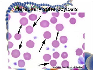 Hereditary spherocytosis
 