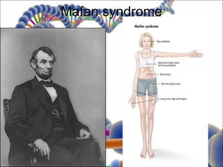 Mafan syndrome
 