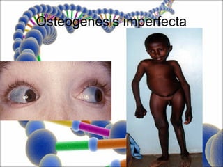 Osteogenesis imperfecta
 