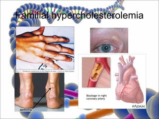 Familial hypercholesterolemia
 
