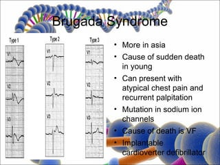 Brugada Syndrome
        • More in asia
        • Cause of sudden death
          in young
        • Can present with
          atypical chest pain and
          recurrent palpitation
        • Mutation in sodium ion
          channels
        • Cause of death is VF
        • Implantable
          cardioverter defibrillator
 