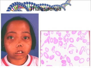 Thalasaemia
 