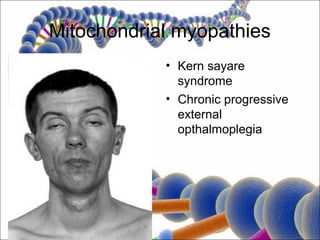 Mitochondrial myopathies
            • Kern sayare
              syndrome
            • Chronic progressive
              external
              opthalmoplegia
 