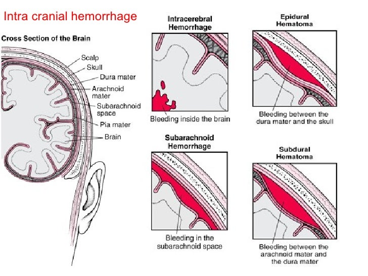 Different Types Of Brain Hemorrhage