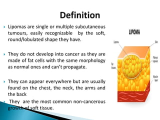 Lipoma meaning