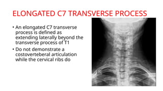 Presentation (10)-4.pptx imaging in Thoracic outlet syndrome | PPTX
