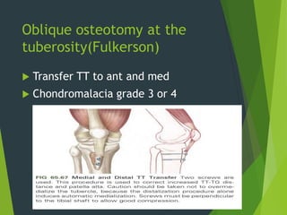 Oblique osteotomy at the
tuberosity(Fulkerson)
 Transfer TT to ant and med
 Chondromalacia grade 3 or 4
49
 