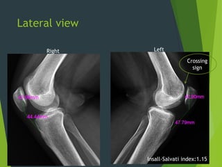 5
Lateral view
Crossing
sign
Insall-Salvati index:1.15
Right Left
 