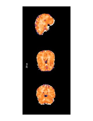 ultra-short echo time MRI for myelin imaging