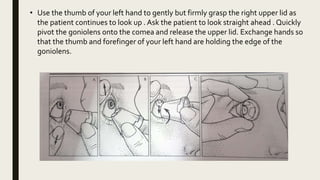 • Use the thumb of your left hand to gently but firmly grasp the right upper lid as
the patient continues to look up . Ask the patient to look straight ahead . Quickly
pivot the goniolens onto the comea and release the upper lid. Exchange hands so
that the thumb and forefinger of your left hand are holding the edge of the
goniolens.
 