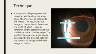 Technique
■ A narrow slit of light is projected
onto the peripheral cornea at an
angle of 60° as near as possible to
the limbus.This results in a slit
image on the surface of the cornea ,
the width of which is used as
reference for the assessment of the
conditions in the chamber angle.The
width of the chamber angle can be
described by the distance between
the corneal slit image and the slit
image on the iris .
 