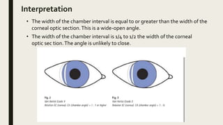 Interpretation
• The width of the chamber interval is equal to or greater than the width of the
corneal optic section.This is a wide-open angle.
• The width of the chamber interval is 1/4 to 1/2 the width of the corneal
optic sec tion.The angle is unlikely to close.
 