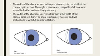 • The width of the chamber interval is approxi mately 1/4 the width of the
corneal optic section.The angle is narrow and is capable of closure.And
should be further evaluated by gonioscopy.
• The width of the chamber interval is less than 4 the width of the
corneal optic sec- tion.The angle is extremely nar: row and will
probably close with full pupillary dilation.
 