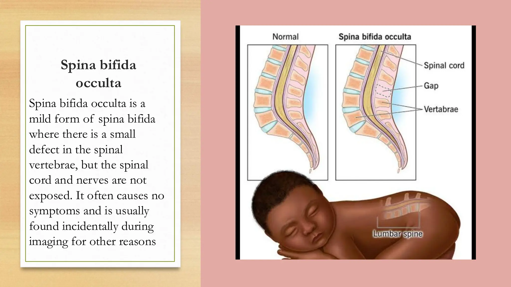 Spinal Defet presentation on spinal defects and deformities | PDF