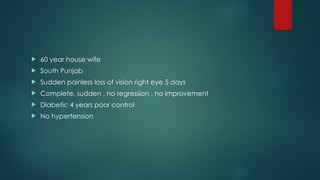  60 year house wife
South Punjab
Sudden painless loss of vision right eye 5 days
Complete, sudden , no regression , no improvement
Diabetic 4 years poor control
No hypertension