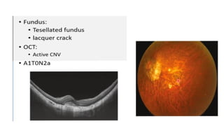Xanthopsia Simulation Presentation of pathological myopia a rare scenario.pptx