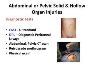 Abdominal-injuries-in-sports.pptx