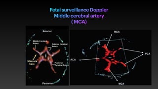 Fetal surveillance Doppler


Middle cerebral artery


( MCA)


 