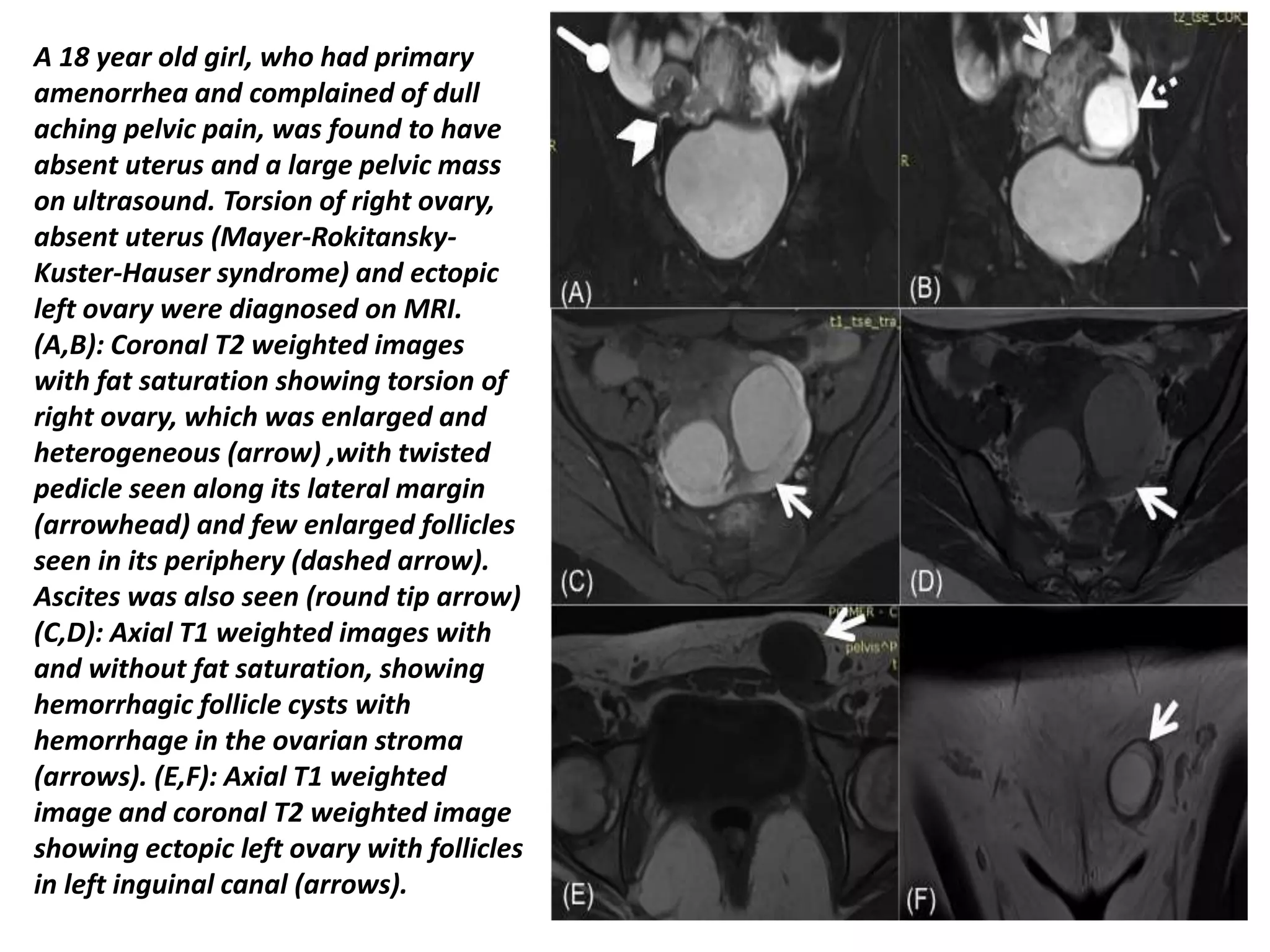 Presentation11 Radiological Imaging Of Ovarian Torsion PPTX Presentation11 Radiological Imaging Of Ovarian Torsion PPTX