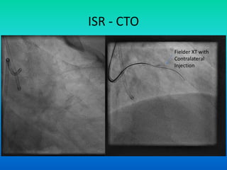 Cto Dual Injection CTO | PPTX