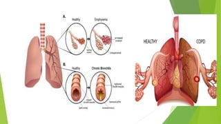 COPD | PPTX