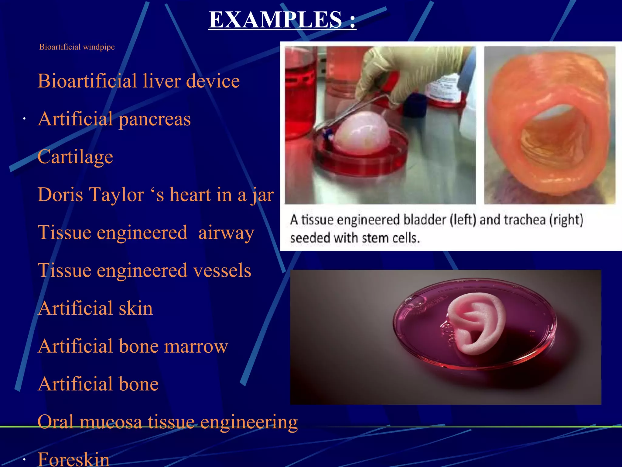 Bioartificial windpipe
Bioartificial liver device
· Artificial pancreas
Cartilage
Doris Taylor ‘s heart in a jar
Tissue engineered airway
Tissue engineered vessels
Artificial skin
Artificial bone marrow
Artificial bone
Oral mucosa tissue engineering
· Foreskin
EXAMPLES :
 