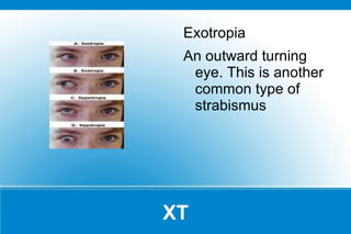 Inflammation of the middle ear 