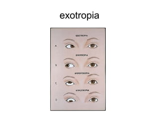 exotropia
 