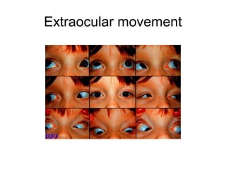 Extraocular movement
 