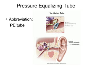 Pressure Equalizing Tube
• Abbreviation:
PE tube
 