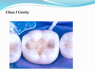 Class I Cavity
 