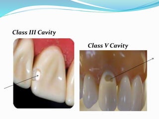 Class III Cavity
Class V Cavity
 