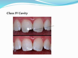 Class IV Cavity
 