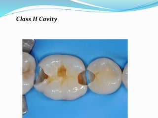 Class II Cavity
 