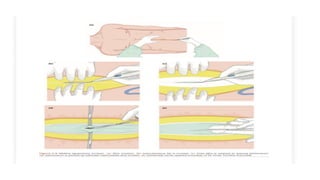 Approximated Incision Healing Ridge Comprehensive Guide to Surgical Exposure and Wound Approximation ...