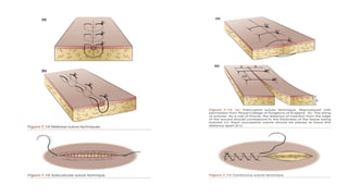 Approximated Incision Healing Ridge Comprehensive Guide to Surgical Exposure and Wound Approximation ...