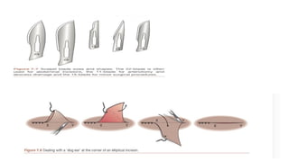 Approximated Incision Healing Ridge Comprehensive Guide to Surgical Exposure and Wound Approximation ...