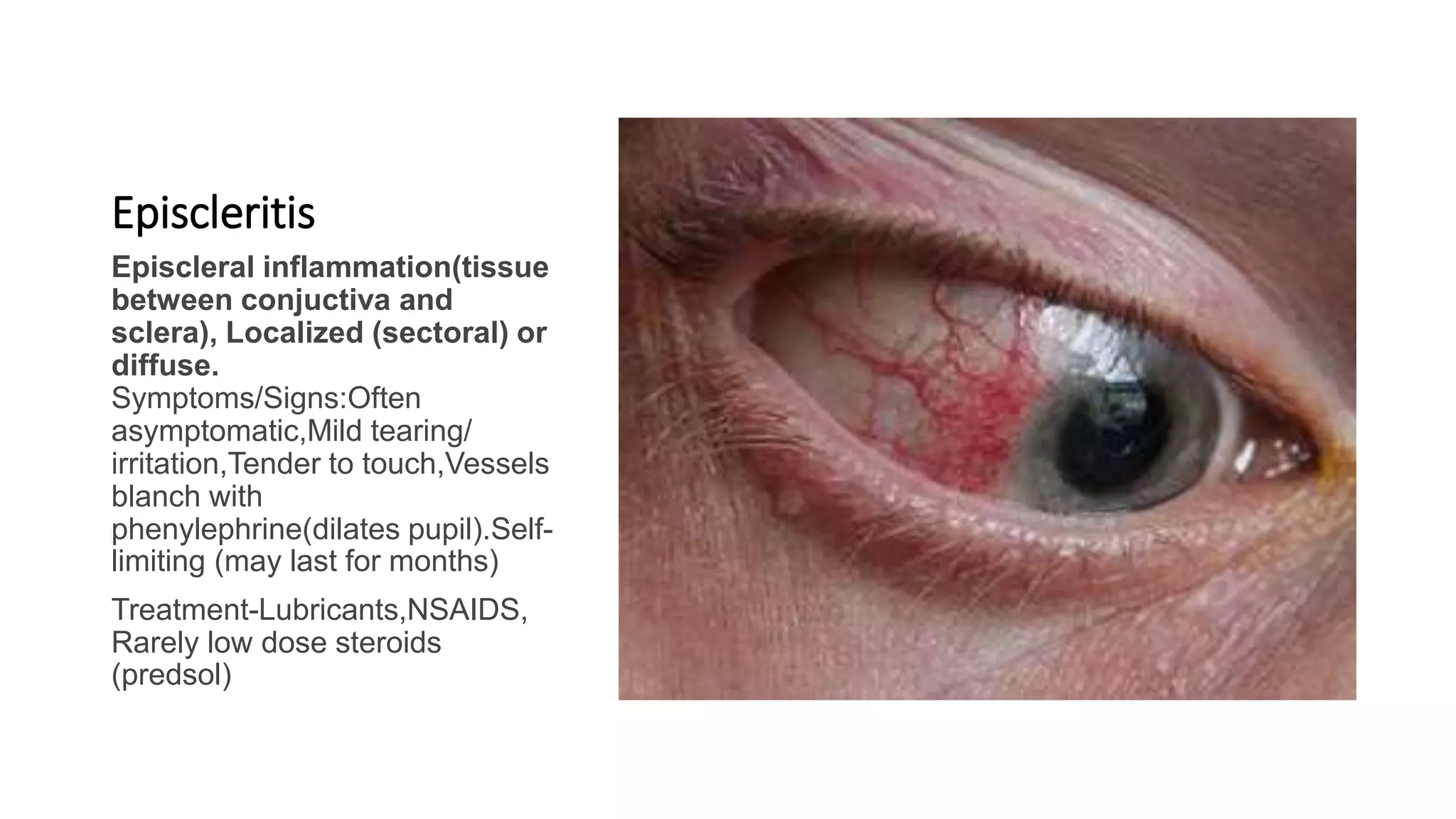 APPROACH TO RED EYE DIAGNOSIS AND TREATMENT PPTX