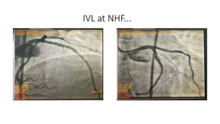 **References:
Forero MN, Daemen J. The coronary intravascular lithotripsy system.
Interventional Cardiology Review 2019; 1...