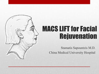 MACS LIFT for Facial
     Rejuvenation
         Stamatis Sapountzis M.D.
  China Medical University Hospital
 