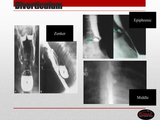 Diverticulum
Epiphrenic
Middle
Zenker
 