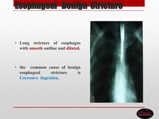 Esophageal Benign Stricture
• Long stricture of esophagus
with smooth outline and dilated.
• the common cause of benign
esophageal stricture is
Corrosive Ingestion.
 