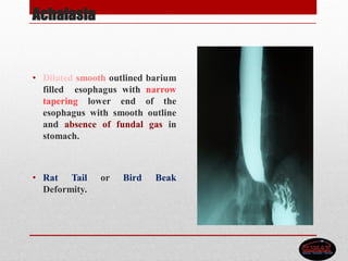 Achalasia
• Dilated smooth outlined barium
filled esophagus with narrow
tapering lower end of the
esophagus with smooth outline
and absence of fundal gas in
stomach.
• Rat Tail or Bird Beak
Deformity.
 