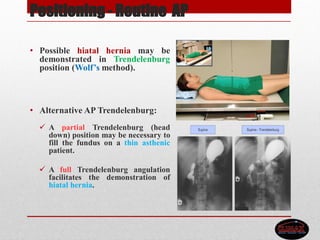 Positioning - Routine AP
• Possible hiatal hernia may be
demonstrated in Trendelenburg
position (Wolf’s method).
• Alternative AP Trendelenburg:
 A partial Trendelenburg (head
down) position may be necessary to
fill the fundus on a thin asthenic
patient.
 A full Trendelenburg angulation
facilitates the demonstration of
hiatal hernia.
 